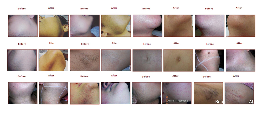 Laser hair removal Solihull